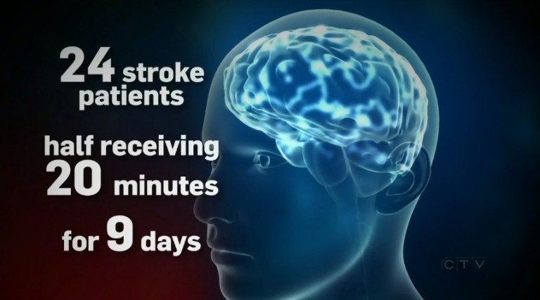 Electrical brain stimulation can help recovery from stroke | CTV | DIY tDCS